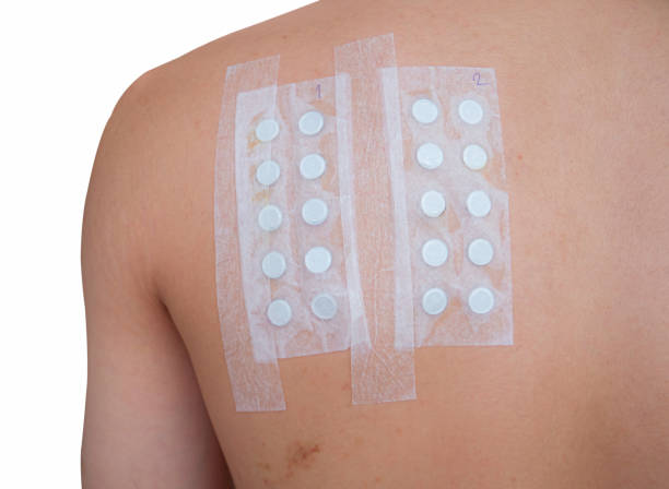 istock Applying Patch Test to test for chronic allergic rash from chemical exposure through skin. Skin allergy test strips. 1391859841