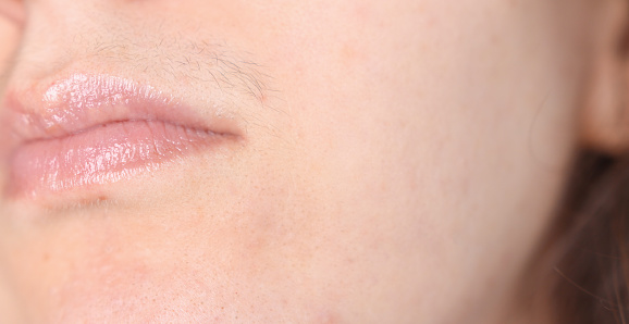 Close-up of a woman's face with hair above the upper lip. Impaired metabolism, increased testosterone in a girl