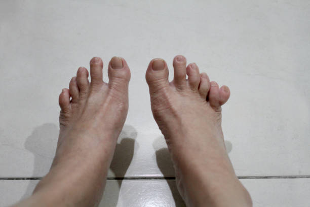 Rare Toes 70+ Unusual Toe Stock Photos, Pictures & Royalty-Free Images - iStock
