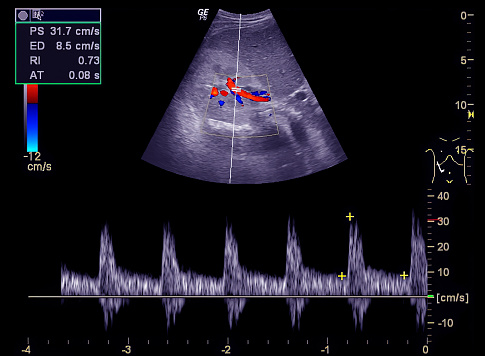 Ultrasound upper abdomen showing flow in common bile duct  after use color Doppler.