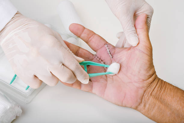 Doctor doing wound dressing care, Hand surgery treatment, Trigger finger stiffness painful, Doctor treat patient's hand injury in hospital, Wound stitches at index and middle finger. stock photo