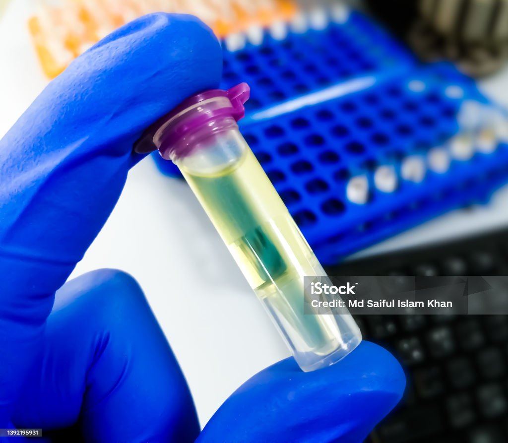 Eppendorf Tube with Cerebrospinal fluid (CSF) sample for pathological study including biochemistry, cytology, Gram staining. Analyzing Stock Photo