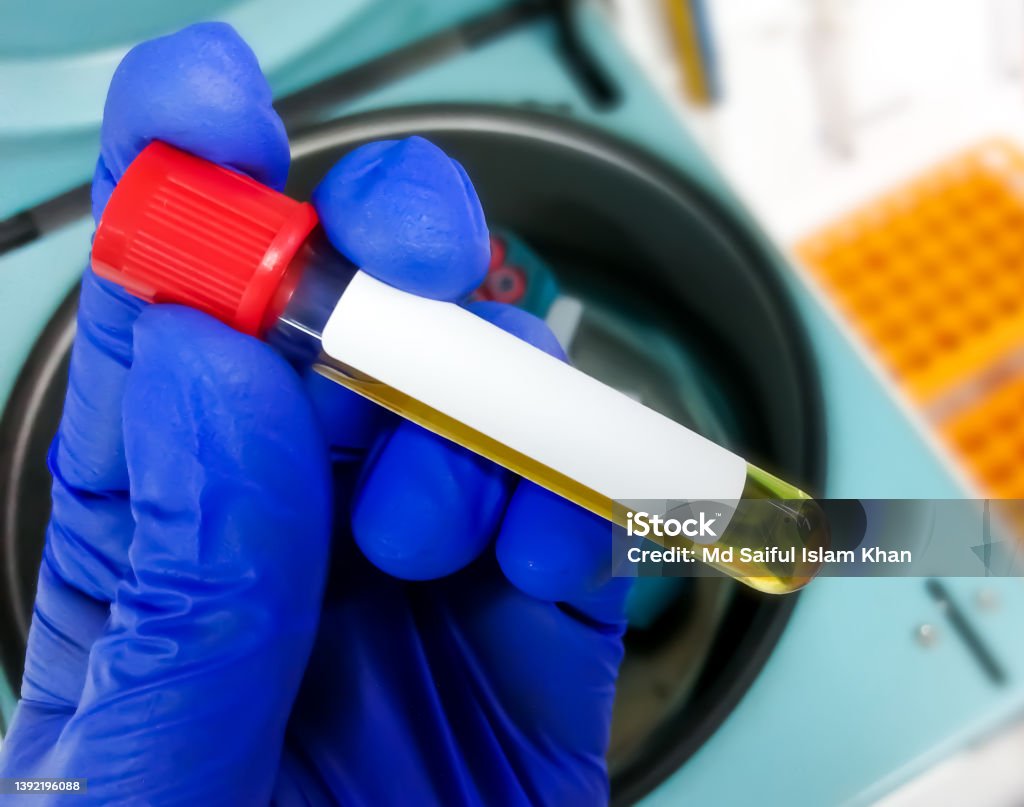 Medical Laboratory Technologist holding pleural fluid sample for medical testing including Biochemistry and Cytology. Analyzing Stock Photo