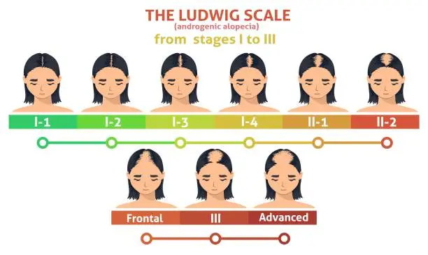 Vector illustration of Ludwig scale of androgenic alopecia step poster