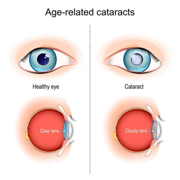 illustrazioni stock, clip art, cartoni animati e icone di tendenza di cataratta. problemi di vista legati all'età. - cataratta