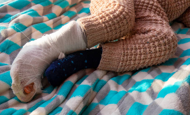 enfant avec bandage sur la fracture du talon de la jambe. pied droit cassé, attelle du bambin. petit garçon dormant sur une couverture bleue - physical injury bandage wound cast photos et images de collection