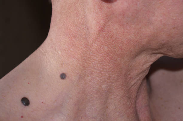 istock Close up of birthmarks on neck and shoulder 1392376315