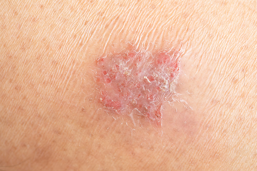 Patch of dry skin on the arm of a caucasian senior man.