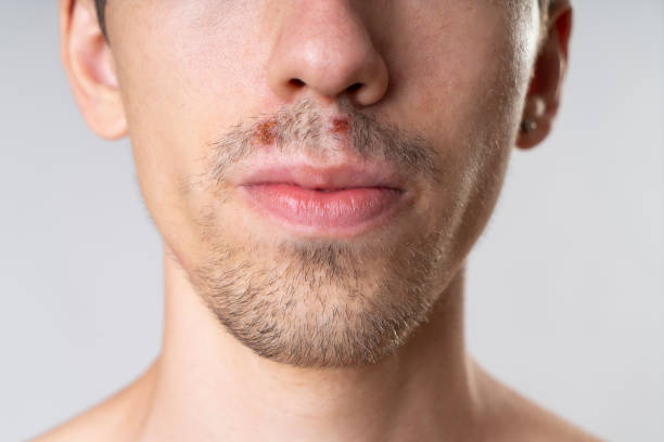 A close-up of a young man with herpes viral cold -oral infection - Angular Cheilitis on his lip and mouth A close-up of a young man with herpes viral cold -oral infection - Angular Cheilitis on his lip and mouth Cold Sore stock pictures, royalty-free photos & images