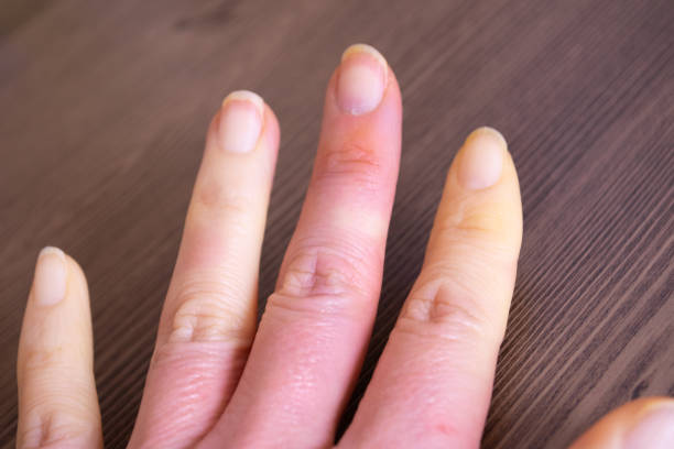 dedos decolorados con los síntomas de la enfermedad de raynaud - discolored fotografías e imágenes de stock