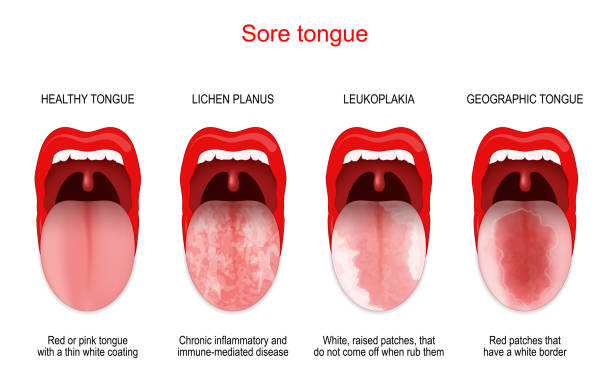 Sore or white tongue. comparison of healthy tongue and oral disease vector art illustration