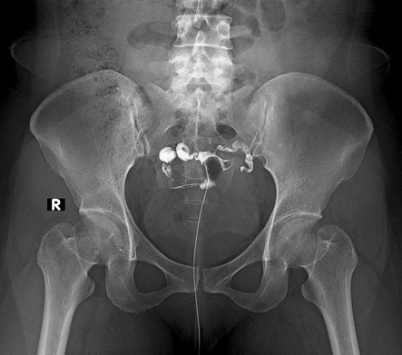 Hysterosalpingography (HSG) shows bilateral tuba fallopian enlargement  and minimal contrast spillage. Hysterosalpingography (HSG) is the radiographic evaluation of the uterus and fallopian tubes.