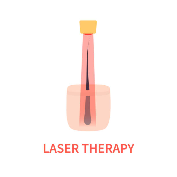 лазерная терапия красным светом лечение алопеции - laser therapy medical laser light therapy stock illustrations