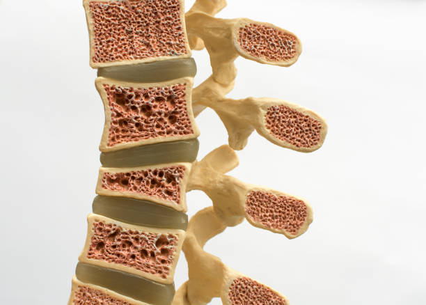 A close-up model of the human spine on a white background showing various defects in the bones and vertebrae. From top to bottom: normal vertebral bone, osteoporotic bone, wedge fracture, compression fracture. stock photo