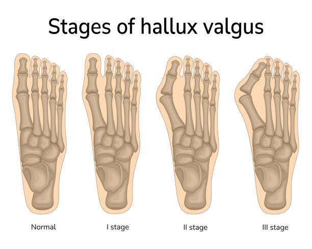 Stages of hallux valgus Three stages of valgus deformity of the big toe sports medicine stock illustrations