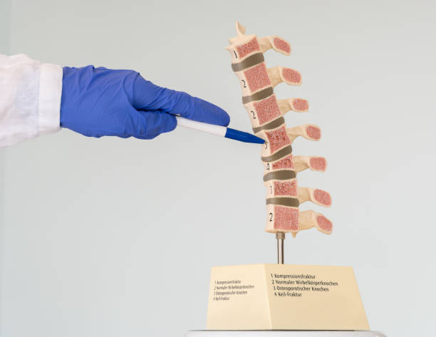 der arzt demonstriert ein modell der menschlichen wirbelsäule, das verschiedene defekte in knochen und wirbeln aufweist. inschriften auf dem modell: 1-kompressionsfraktur, 2-normaler wirbelknochen, 3-ostioporotischer knochen, 4-keilfraktur. - wirbelkanal stock-fotos und bilder