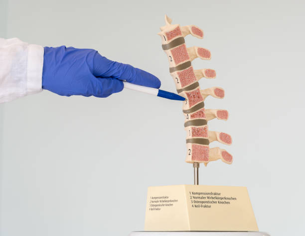 врач демонстрирует модель позвоночника человека, которая показывает различные дефекты костей и позвонков. надписи на модели: 1-компрессион - vertebral body стоковые фото и изображения