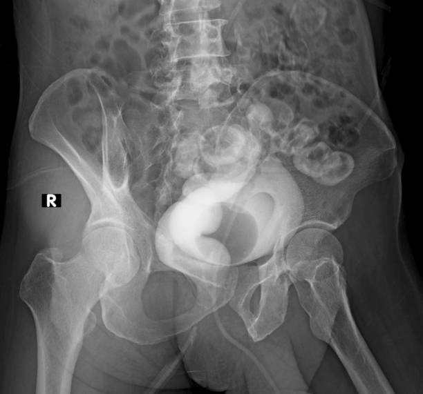 istock X ray image of rectovesical fistula 1393100027