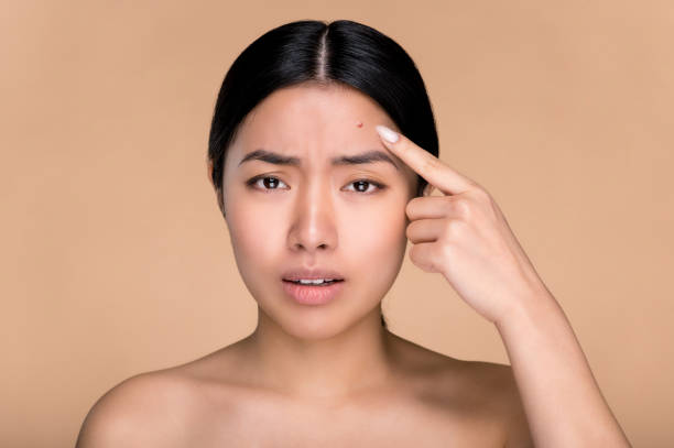 problem skin concept. upset asian girl with nude shoulders, with problem skin, pointing finger at pimple on forehead while standing over isolated beige background, sadly looks at camera - women tan perfection naked imagens e fotografias de stock