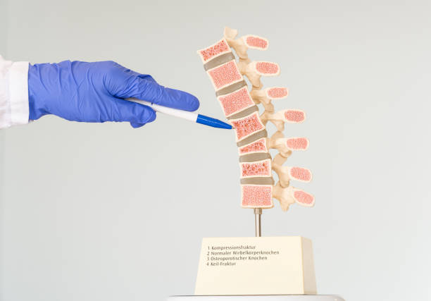 der arzt zeigt ein modell der menschlichen wirbelsäule, das verschiedene defekte in den wirbeln aufweist. inschriften auf dem modell: 1-kompressionsfraktur, 2-normales wirbeltier, 3-osteoporotischer knochen, 4-keilfraktur. - wirbelkanal stock-fotos und bilder