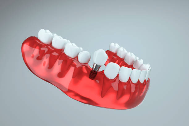 istock 3d image of tooth implant going to jaw bone 1393120724
