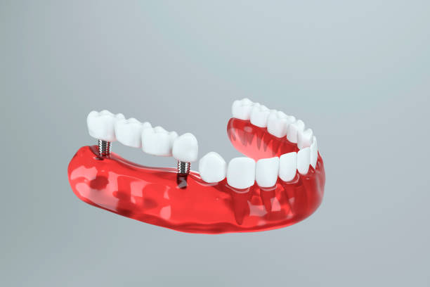 istock 3d image of tooth implant going to jaw bone 1393120725