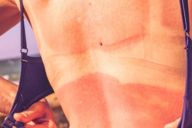 istock Woman back skin hurt from sun burn. 1393135644