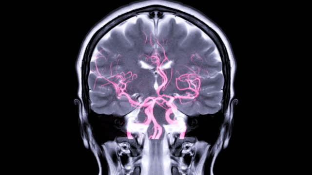 MRA Brain or Magnetic resonance angiography of Cerebral artery in the brain compare Coronal T2W.