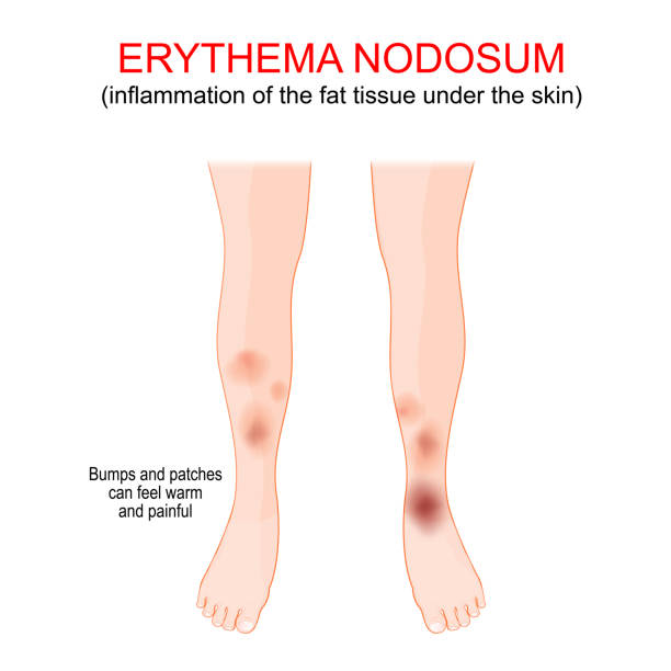 Erythema nodosum. inflammation of the fat tissue under the skin. Erythema nodosum. inflammation of the fat tissue under the skin. Bumps and patches that feel warm, painful and firm. vector illustration erythema nodosum stock illustrations