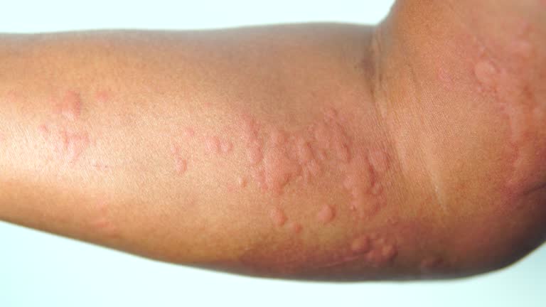 Sensitive Skin Rahs 2,000+ Skin Rash Stock Videos and Royalty-Free Footage - iStock