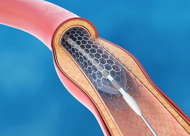 Stent Implantation for Blood Circulation Stent Implantation for Blood Circulation catheter stock pictures, royalty-free photos & images