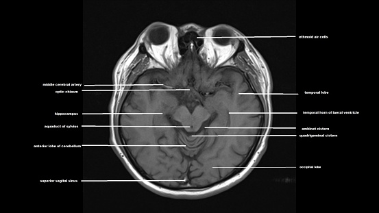 Magnetic resonance images of the brain (MRI brain). Computed resonance imaging of the human brain.