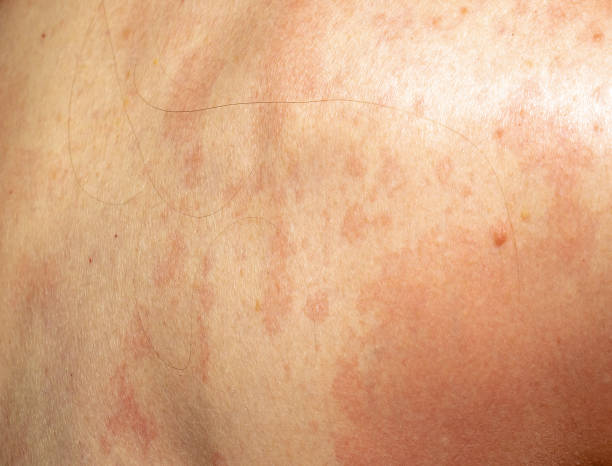 istock Psoriasis on skin 1393395782