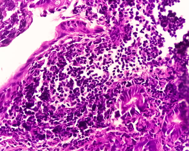 tejido del íleon terminal: la ileítis crónica inespecífica o inflamación del íleon, a menudo es causada por la enfermedad de crohn. enfermedad inflamatoria intestinal (eii). - micrografía de luz fotografías e imágenes de stock