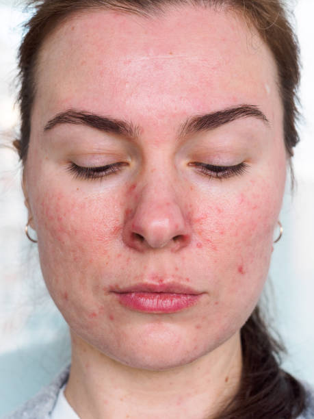 istock front face of a patient with rosacea 1393598942