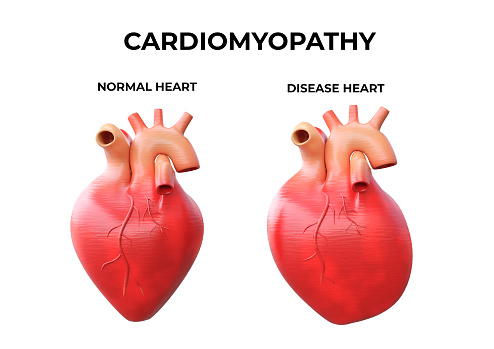 Cardiomyopathy is inflammation in the heart muscle, resulting in its enlargement and weakening that impairs the blood's pumping ability. 3D illustration
