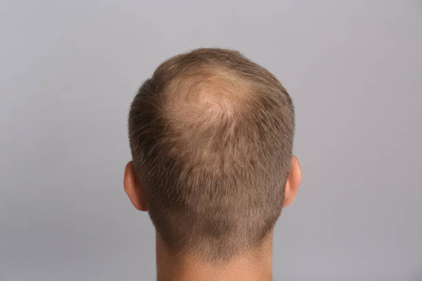 istock Man with hair loss problem on grey background, back view. Trichology treatment 1393779812