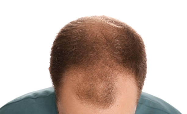 istock Man with hair loss problem on white background, closeup. Trichology treatment 1393780129