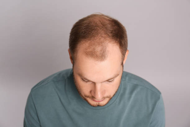 Hair Loss: Medications & Treatment Options 