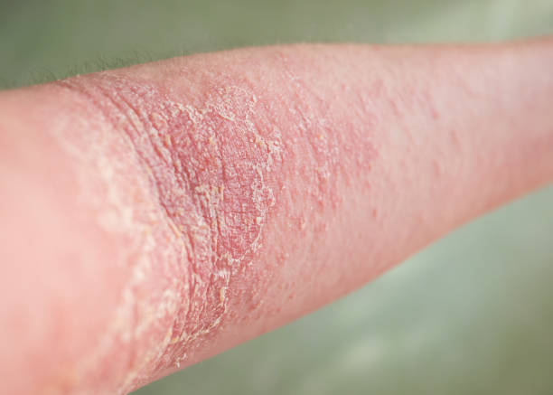 Close-up view of the eczema on a person's arm. stock photo