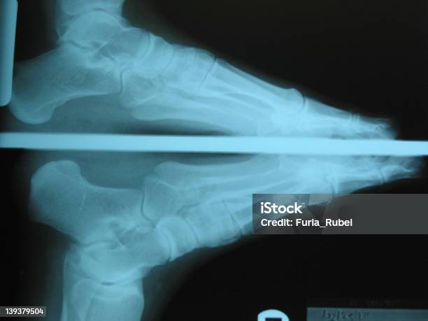 Xray Pie Foto de stock y más banco de imágenes de Articulación humana - Articulación humana, Asistencia sanitaria y medicina, En el fondo