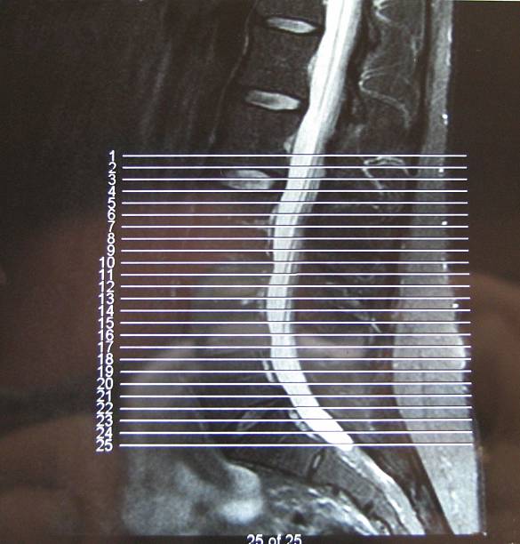 MRI spine curvature stock photo