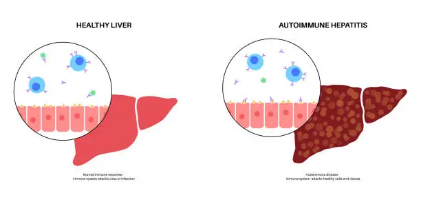 Vector illustration of Autoimmune hepatitis disease