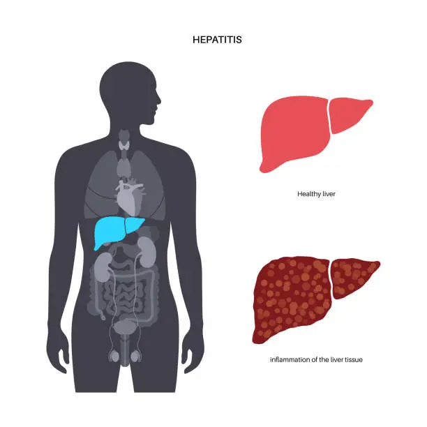 Vector illustration of Autoimmune hepatitis disease