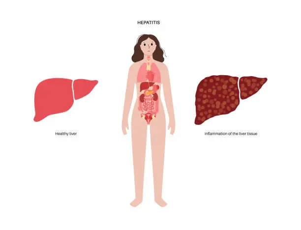 Vector illustration of Autoimmune hepatitis disease