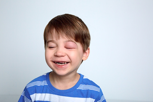 Child with swollen eye from insect bite. Face of allergic person. Allergy. Quincke edema. Portrait of laughing European appearance boy. Studio background. Isolated. Happy mood. Bruising after fight.