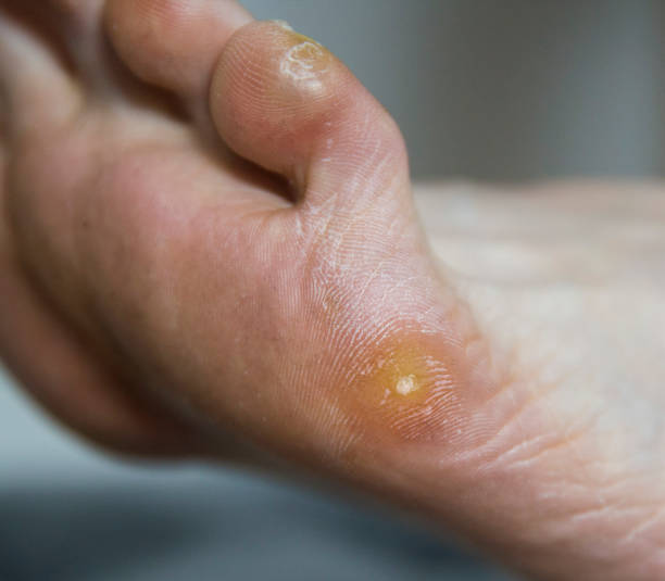 환자의 발에 질경이 사마귀와 굳은 살. 사��마귀의 제거와 발바닥의 피부 관리, 매크로 - pacient 뉴스 사진 이미지