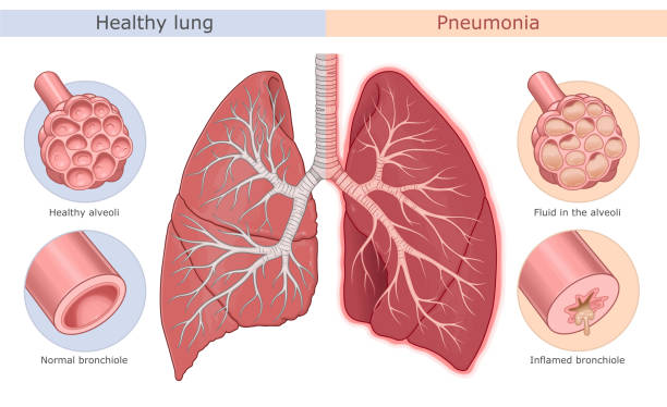 Pneumonia symptoms medical diagram Pneumonia symptoms medical diagram. Healthy lung and lung with pneumonia. bronchiole stock illustrations