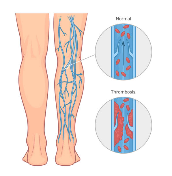 Deep vein thrombosis illustration Deep vein thrombosis or DVT vector medical illustration. Healthy and unhealthy vein. blood clot stock illustrations