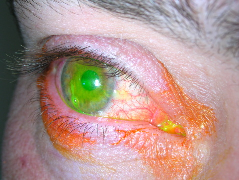 Yellow stain of the eye for corneal injury